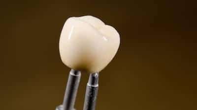 Close up of a dental crown in Seattle, WA at Phinney Ridge Dental 